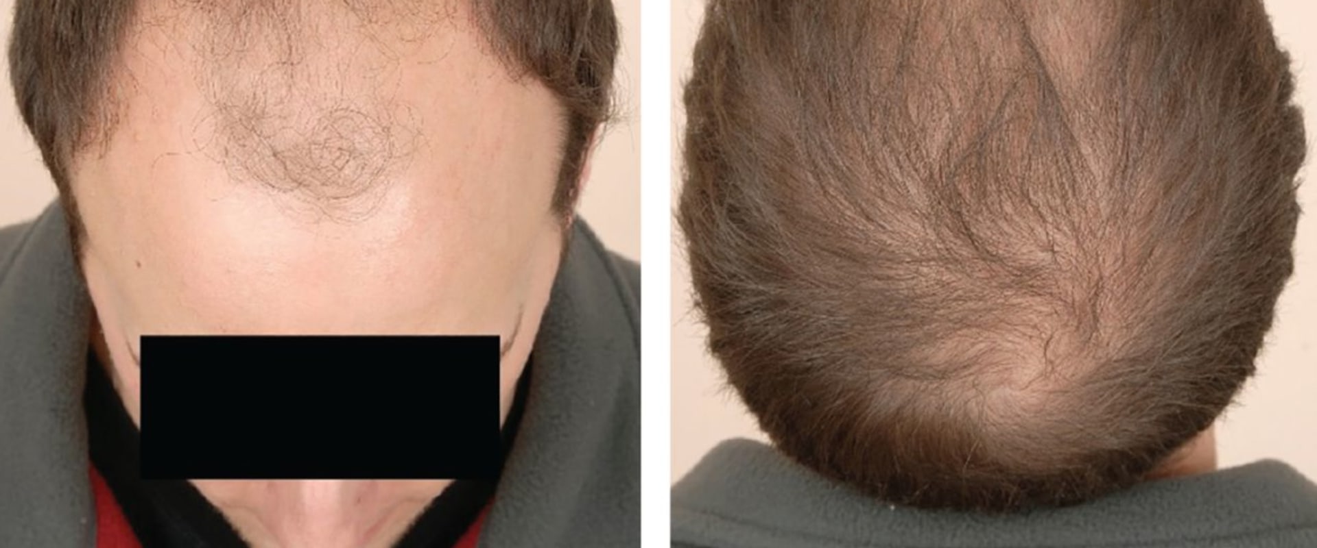 Diagnosing Male Pattern Baldness: Understanding Causes, Prevention, and Treatment Options