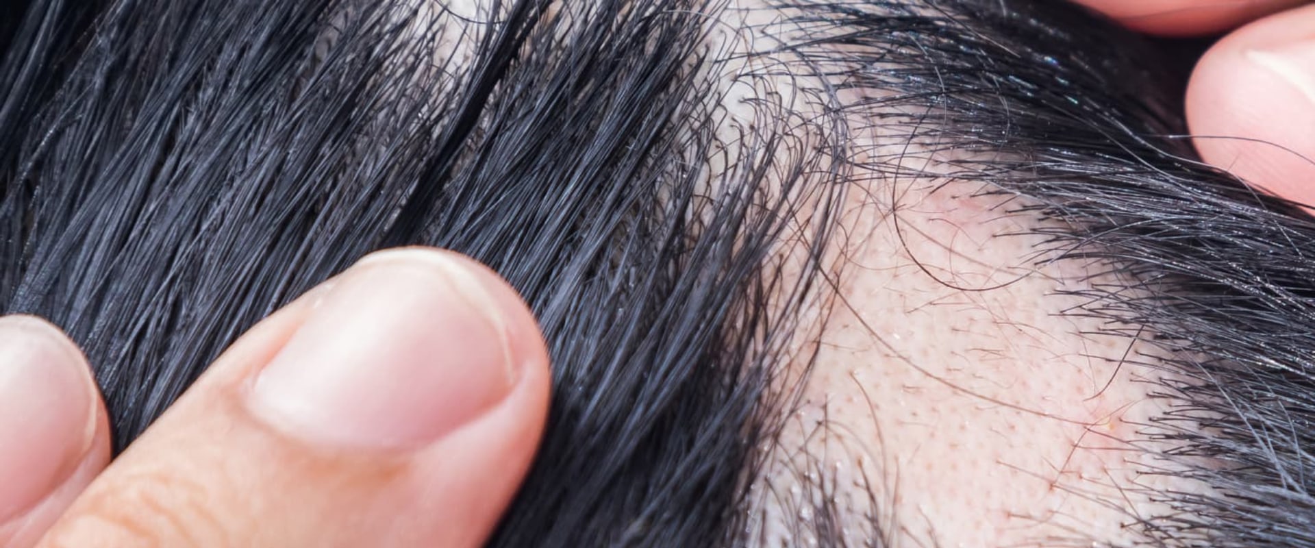 Understanding Alopecia: Causes, Treatments, and Prevention