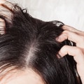 Scalp Exfoliation and Deep Cleaning: The Key to Preventing Hair Loss