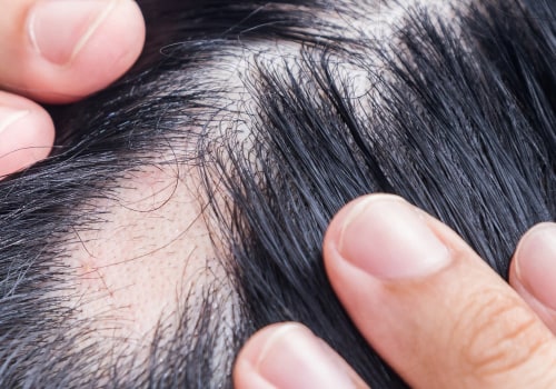Understanding Alopecia: Causes, Treatments, and Prevention